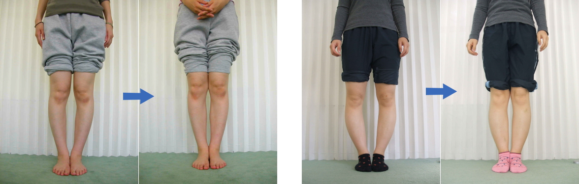 O脚ビフォーアフター