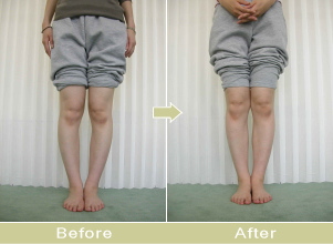 XO脚矯正写真