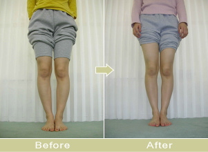 XO脚矯正写真