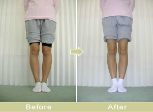 O脚矯正写真