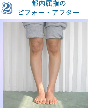 O脚矯正ビフォーアフター